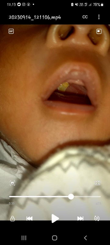 Di langif mulut bayi terdapat warna kuning dan bikin bayi sakit saat nyusu