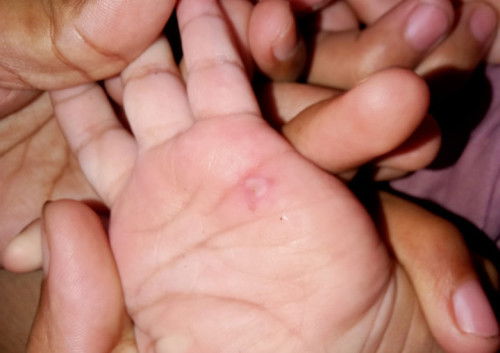 Tangan Bayi korengan bernanah