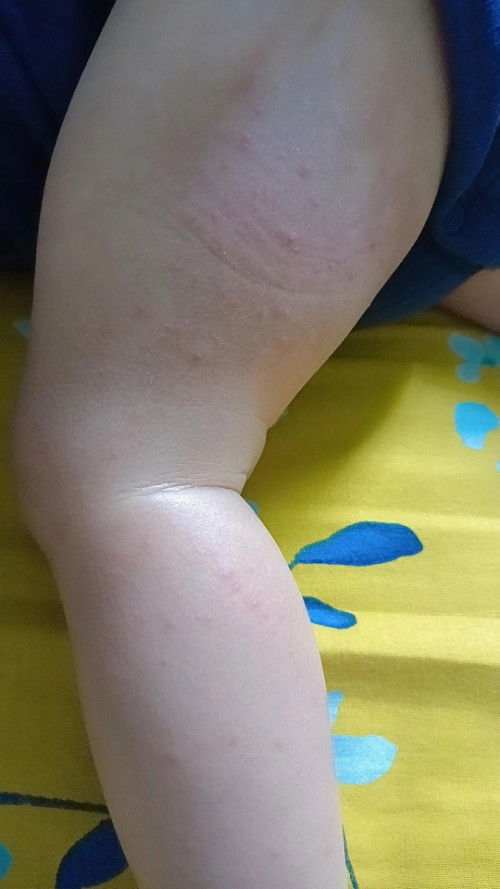 Bintik2 merah dikedua Kaka bayi 9 bln