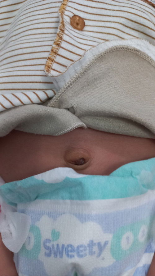 Pusar bayi menonjol keluar