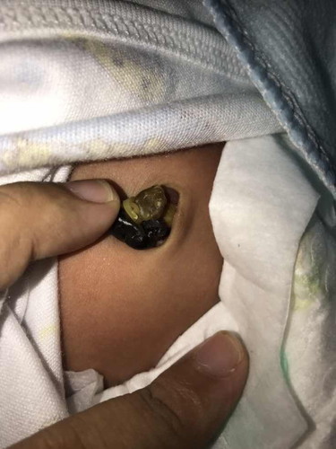 สะดือน้องแบบนี้ปกติรึเปล่า