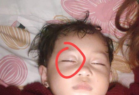 Kelopak mata anak seperti ada benjolan