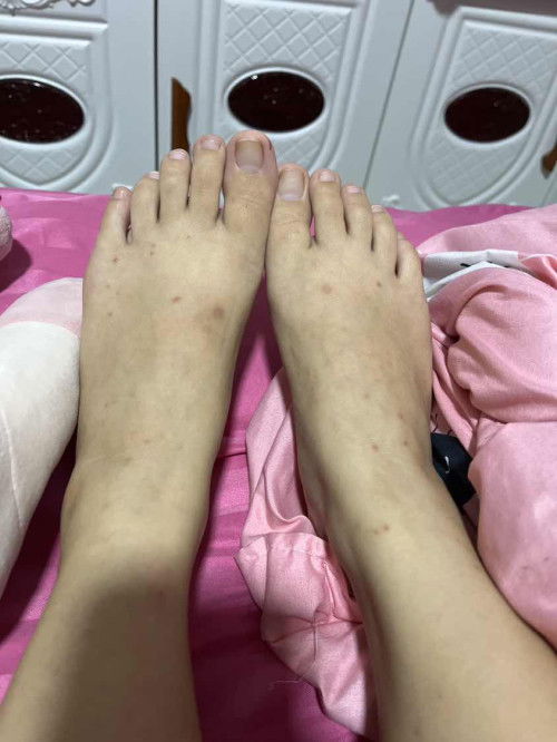 ท้องแล้วคันเท้า