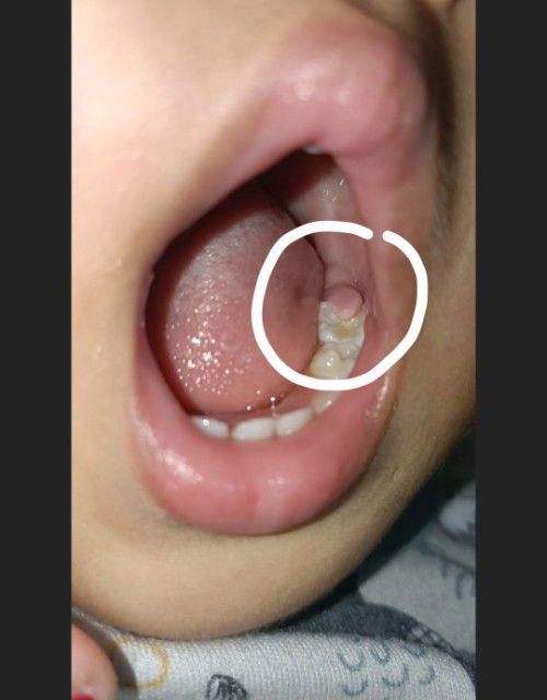 Assalamualaikum bunda2 mau tanya dong.. ini kira2 knp ya seperti ada daging tumbuh di gusi anakku