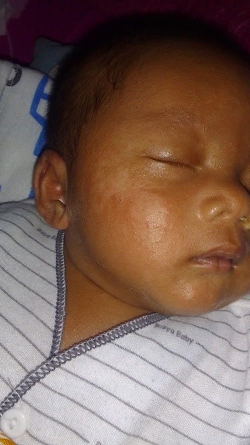 Bunda apa ya obatnya bruntusan smpai muncul putih ketika bruntusannya kering