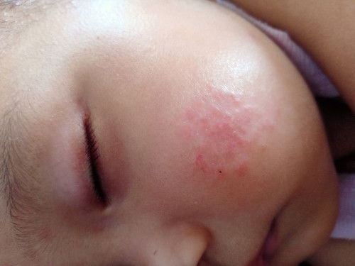 Muncul bintik di pipi, lama kelamaan melebar dan gatal.