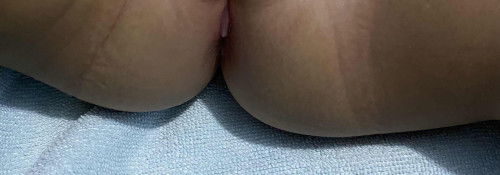 Daging tumbuh antara kelamin & anus