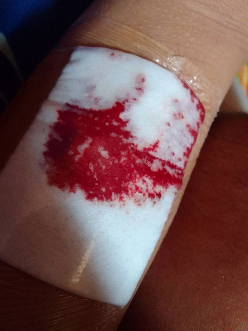 halo bun aku baru aja lepas KB susuk( implan)