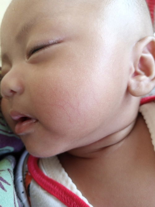 Garis merah di pipi bayi