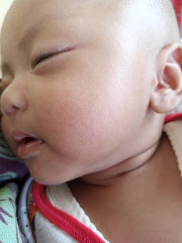 Garis merah di pipi bayi