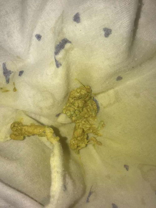 อึน้องเป็นแบบนี้ปกติมั้ยคะ