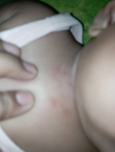 Leher anakku muncul bintik2 banyak Bun pake apa ya nyembuhinnya?