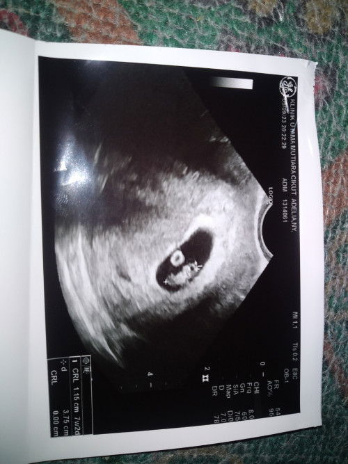 Hamil 9 week,, sudah USG TV..