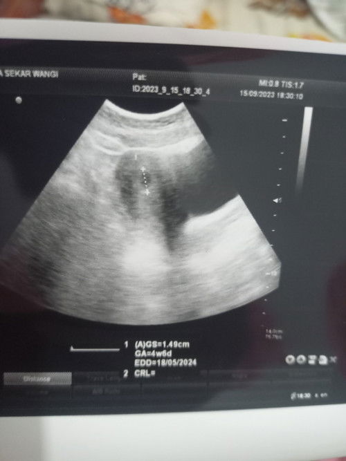 Usia kehamilan USG beda dengan HPHT apakah aman?