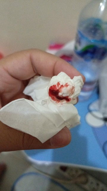 Hamil 30 minggu, setiap hari mimisan g keputihan banyak banget.. solusinya bund..