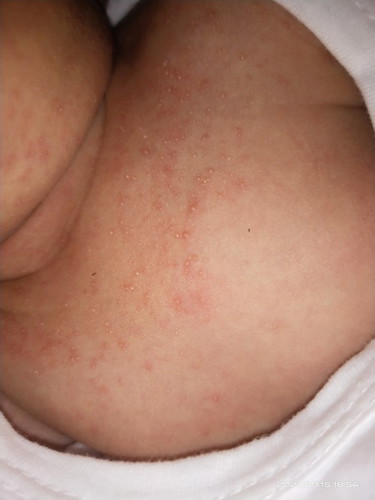 Skin rashes