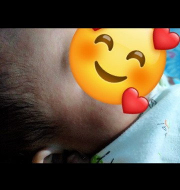 Biang keringat atau alergi