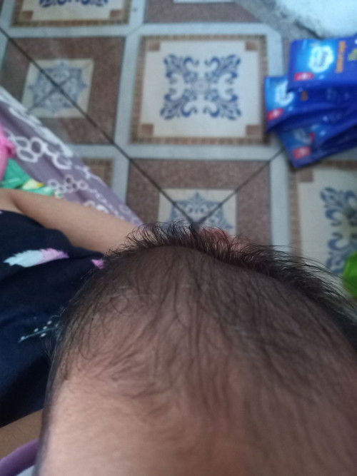 Dari lahir kepala bayi nonjol empuk tapi uda 13 hari masi sama? Kenapa ya bun? Kata bidan itu gpp