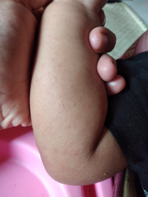 tangan anak bintik merah2
