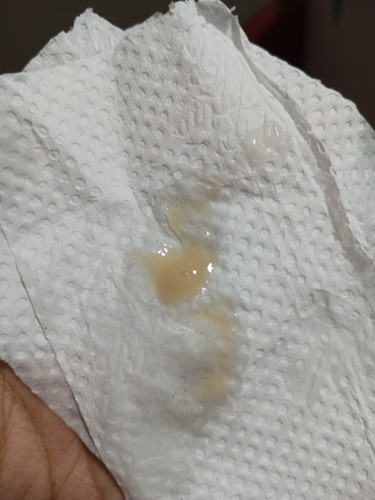 DISCHARGE ( 7weeks pregnant)