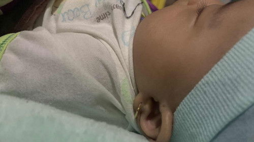 Lubang kecil seperti bekas tindik di telinga atas