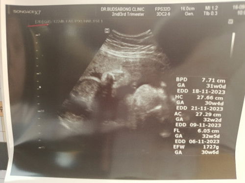 แชร์ๆเรื่องราวแม่ท้อง 29 week 6day ลูกสาวกลับหัวรอแล้ว เริ่มลุกไม่ไหวแล้ว