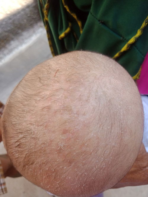 Kerak kepala pada bayi