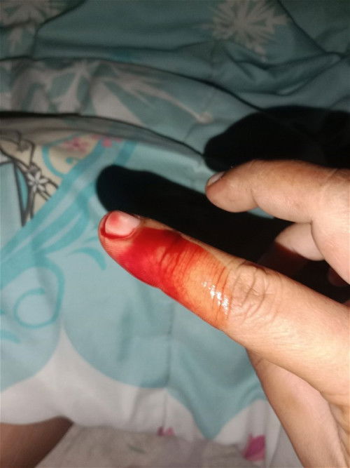 ผ่าคลอดได้1อาทิตย์