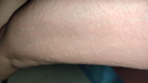 Skin rashes during third trimester.