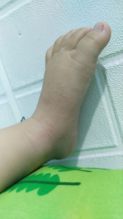 Kaki baby saya beruntusan, mohon bantu jawab cara mengatasi nya ya bunda2. Terimakasih