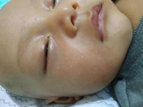 Bintik putih di wajah bayi