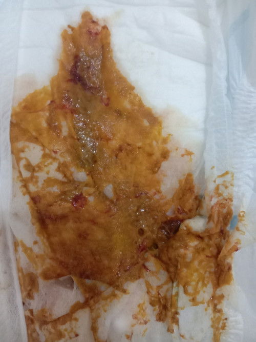 Bayi 8bulan kena Infeksi Usus