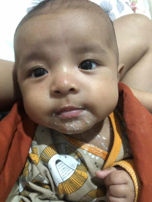 Bayi 2 bulan gumoh bayak