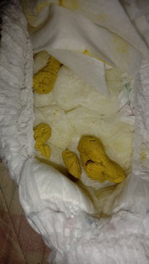 เด็ก 3 เดือน ถ่ายแบบนี้ปกติไหมคะ ถ่ายแบบนี้ควรไปหาหมอไหม