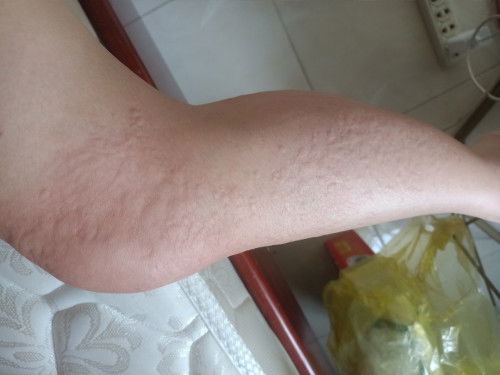 Bâu 27 tuần bị dị ứng nổi mẫn ngứa cả người