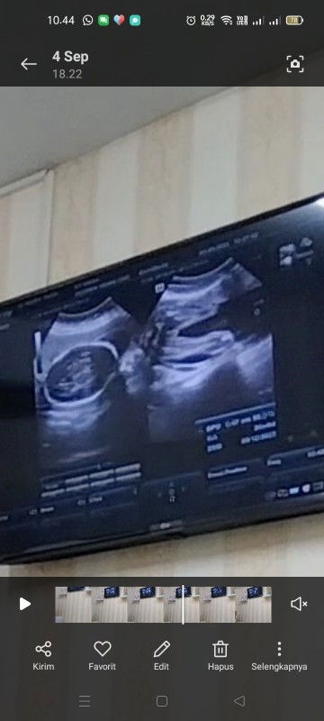 Usg saat 16w dokter bilang cowok, saat masuk 6bln jadi cewek...