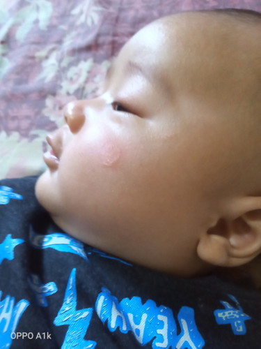 Ilangin ruam pipi