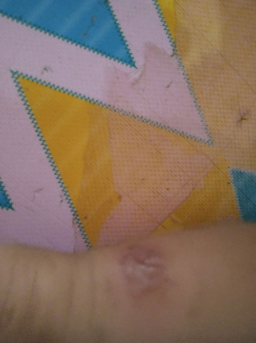 Salep gatel yang aman untuk anak usia 15 bulan apa ya bund?