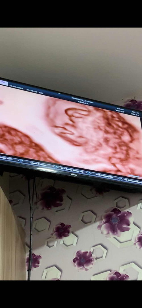 usia kandungan 10weeks