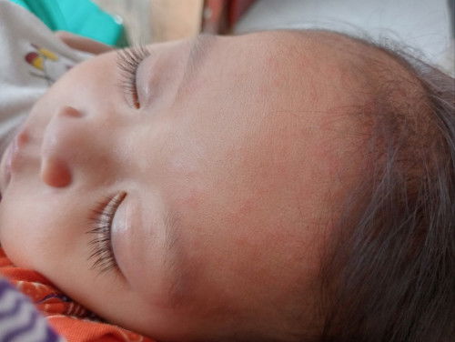 Kemerahan pada kepala saat demam