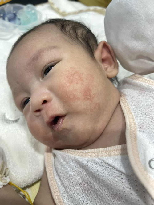 ลูกแม่ๆ ใครเคยเป็นบ้างค่ะ