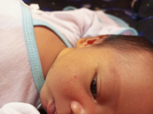 Anong gamot sa butlig 2 weeks palang po si baby