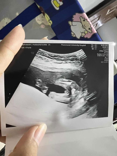 กำหนดคลอด ก.พ67