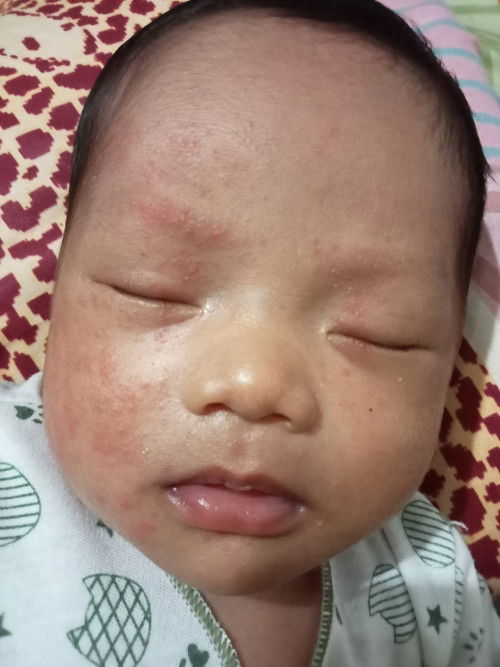 Kulit Merah Bruntusan