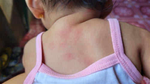 Ano pwedeng ipahid sa ganito?! 5mons old baby❤