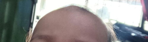 Metopic synostosis (trigonochepaly)