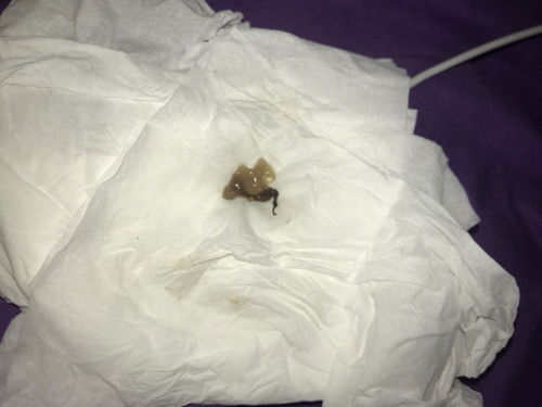 Keputihan flek coklat