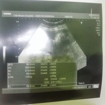 กำหนดคลอดในใบซาวด์​