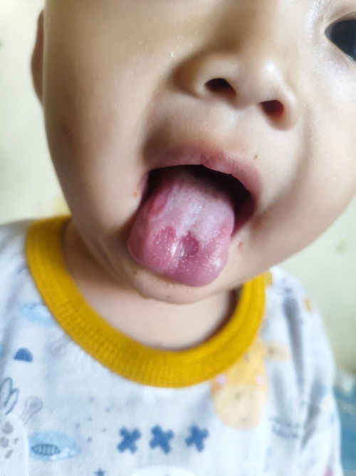 Sariawan atau Bukan?