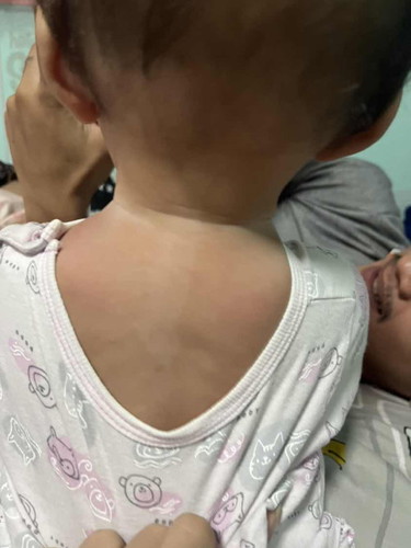 ปานขาว ลูก8เดือน